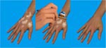 APPLICATION Vitiligo Dermask Permatan