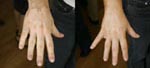PHOTOS certifiées sans trucage Vitiligo Dermask Permatan