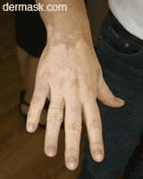 dermask vitiligo