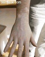 dermask vitiligo