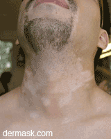 dermask vitiligo