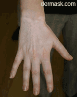 dermask vitiligo